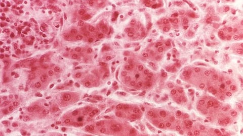 One of the deadliest forms of cancer is biliary tract cancer. Only one in three patients diagnosed with the disease is operable. The rest must settle for life-sustaining treatment (representational image - CDC PHIL)