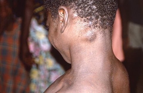 Monkeypox can spread through contaminated clothing (representational image - CDC PHIL)