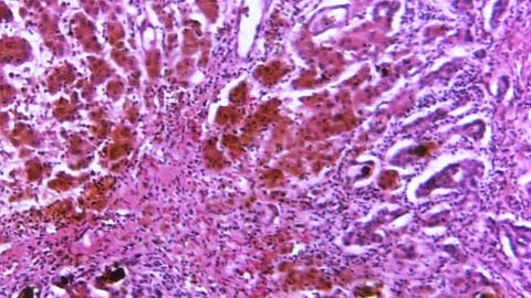 Researchers have designed a microfluidic platform that incorporates different steps that are usually performed by trained personnel in sophisticated settings (representational image - CDC PHIL)