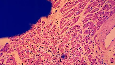 Aging: Heart acquires mutation, loses the ability to repair them (CDC PHIL)