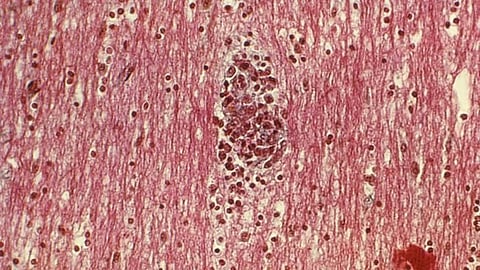 A new study from MIT shows how a type of cells called microglia contribute to this slowdown of neuron activity. Alzheimer’s disease contributes to the cognitive decline that patients experience (representational image - CDC PHIL)