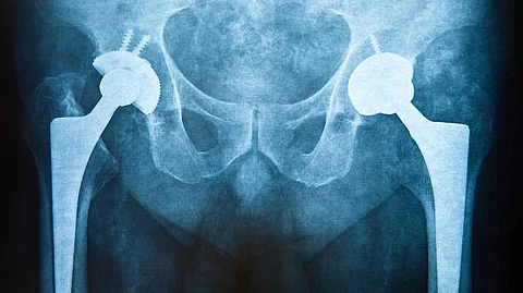 Osteoclast formation were linked with a higher risk of hip fracture in men (Unsplash)