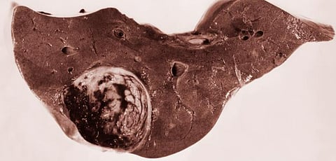 Metastatic growth that had originated from the patient’s thyroid cancer(CDC PHIL)