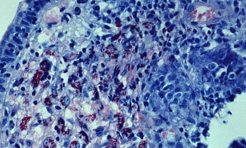 This photomicrograph of an acid-fast-stained small bowel tissue biopsy specimen. (IMAGE: CDC PHIL)