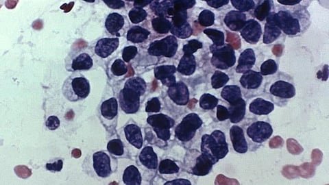 Cancers in adults under 50 on the rise globally. 
  (CDC PHIL)