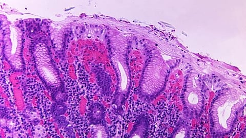 Researchers at McMaster University have discovered a previously unknown bacteria-killing toxin that could pave the way for a new generation of antibiotics (CDC)