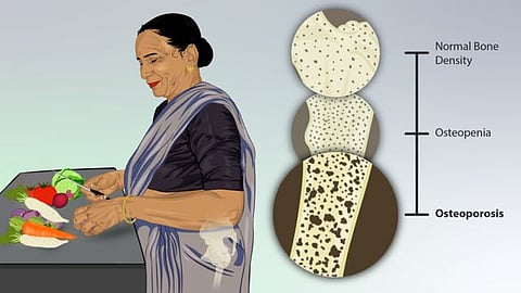 Osteoporosis is a common bone disease that occurs due to a decrease in the density of bone, decreasing its strength and resulting in fragile bones that break or fracture easily.