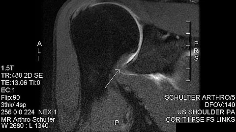 Patients with adhesive capsulitis develop painful and progressive loss of shoulder motion with associated pain. Frozen shoulder is one of the most common shoulder conditions, occurring in up to 10% of people at some time in their lives (Wikimedia Commons)
