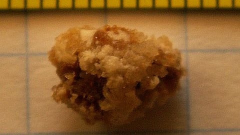 Stones in the ureter, which leads from the kidney to the bladder, can cause severe pain and are a common reason for emergency department visits (Wikimedia Commons)