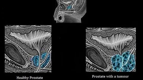 Cribriform prostate cancer is an aggressive subtype of the disease characterized by its histology, but little is known about its molecular pathways.
