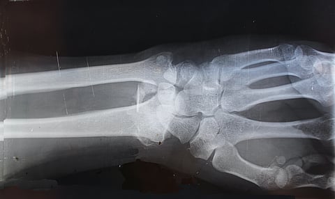 Arthritis encompasses more than 100 conditions that affect the joints, tissues around the joint, and other connective tissues. (Representational Image: Unsplash)