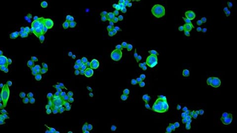 Colorectal cancer is the third most diagnosed cancer in the world and second only to lung cancer in terms of mortality. (Image: Newswise)