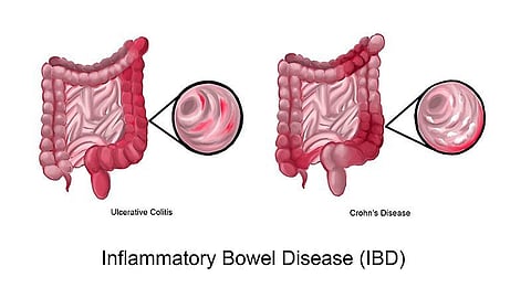 Inflammatory bowel disease is a group of autoimmune diseases that include ulcerative colitis and Crohn's disease (Wikimedia Commons)
