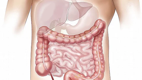 In India, colorectal cancer, which first appears in the colon or the rectum, is the sixth most prevalent cancer to cause mortality.