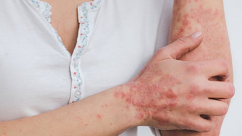 Contact dermatitis is an itchy rash or skin inflammation caused by exposure to physical or chemical irritants.(Image: Pixabay)