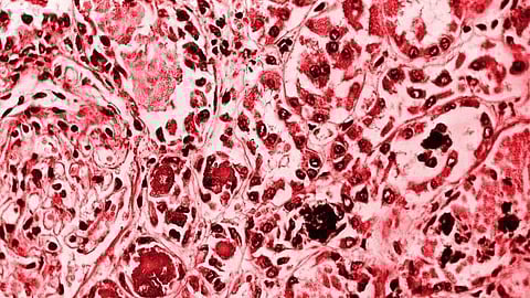 Certain studies have implicated single genetic variants in contributing to different diseases, and these variants can be combined to generate polygenic risk scores (PRS) to predict an individual’s risk of developing such diseases.