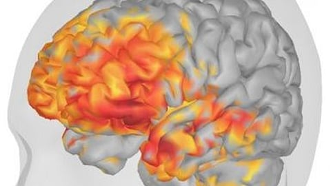Newswise: Study Shows Brain Wave Readings Key to Detecting Concussions
A 3-D rendering shows a 15-year-old male football player's brain. He experienced a helmet-to-helmet collision in a tackling drill and was clinically diagnosed with a concussion, and he received MEG and MRI scans within 72 hours of the injury. The red and yellow area represents increased delta waves in his post-concussion scan, where the darkest red represents the greatest increase(Newswise)