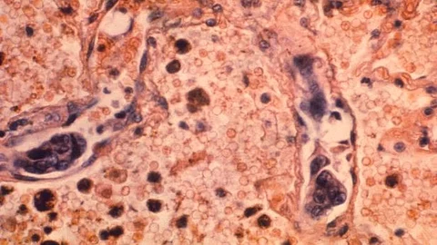 New research findings show how higher viscosity, or resistance to flow, of the extracellular fluid that surrounds cells enables cancer cells to migrate more rapidly from a primary tumor to other sites in the body.