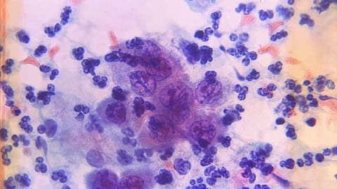 UT Southwestern researchers have identified the molecular function of 87 inherited genetic variants that affect the risk of prostate cancer (CDC PHIL)