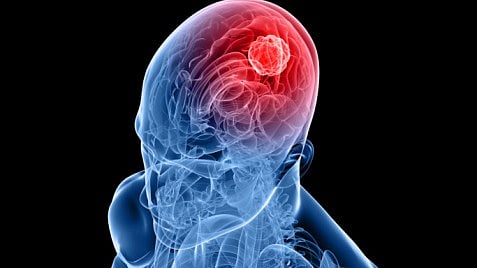 Glioblastomas are incredibly resistant to treatment and have evaded all attempts at precision therapy.