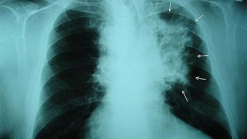 Lung cancer is the deadliest of all cancers. It grows quietly and is usually not detected until it has spread to other parts of the body.