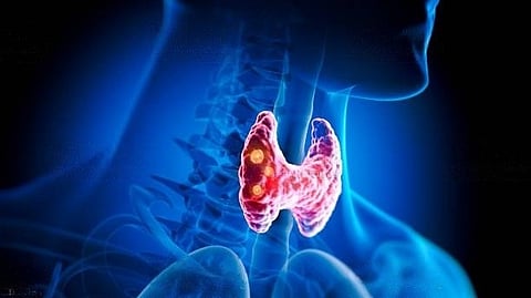 Experts provide framework for treating a common and life-threatening metabolic complication of cancer known as hypercalcemia of malignancy in the Endocrine Society’s new Clinical Practice Guideline.(Unsplash)