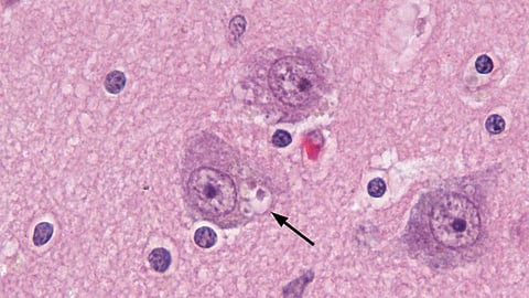 Granulovacuolar degeneration (arrow designates one cluster of vacuoles) in the cytoplasm of pyramidal neurons in the hippocampal formation of a person with Alzheimer's disease. Hematoxylin and eosin stain. Scale bar = 20 microns (0.02mm). (Wikimedia Commons)