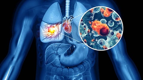 Treatment for lung cancer is rapidly evolving, with new technologies and research-proven procedures