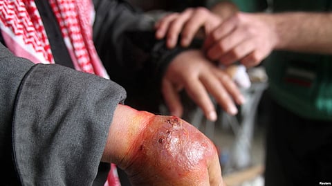A man with a hand showing symptoms of leishmaniasis waits to be treated at a hospital in Aleppo, Syria, Feb. 11, 2013 (VOA)