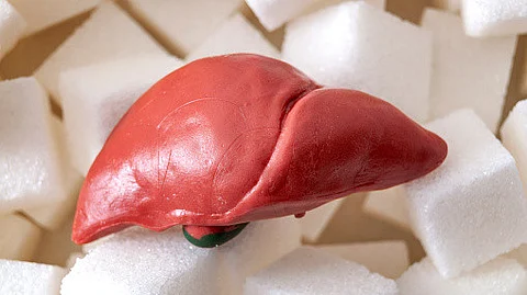 Non-alcoholic Steatohepatitis is the fastest-rising cause of liver cancer worldwide.
