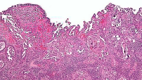 The change will improve care and compensation for responders and survivors who developed uterine cancer after Ground Zero exposure. (WIKIMEDIA COMMONS)