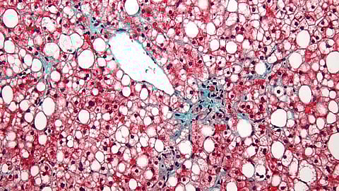 Researchers discovered that people with obesity or diabetes who consume 20% or more of their daily calories from fast food have severely elevated levels of fat in their liver compared to those who consume less or no fast food.