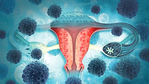 Specific colonization of microbes in the reproductive tract is commonly found in women with ovarian cancer, according to a new study from Mayo Clinic's Center for Individualized Medicine.