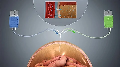 Peritoneal dialysis in case of kidney failure. Wikimedia Commons