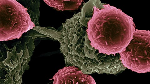 A Ludwig Cancer Research study has discovered that the immune system’s surveillance of cancer can itself induce metabolic adaptations in the cells of early-stage tumors that simultaneously promote their growth and equip them to suppress lethal immune responses.