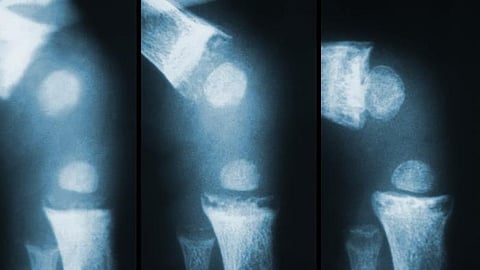 Osteoarthritis is a chronic disease that affects cartilage and surrounding tissues.