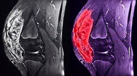 Sarcomas are cancer tumours found in e.g. the bones, muscles, or fatty tissue. It is a rare type of cancer seen in only one percent of cancer patients