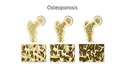 Studies on individual pollutants have suggested adverse effects on bone mineral density, osteoporosis risk, and fractures in older individuals.