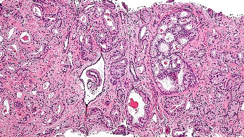 Micrograph showing prostatic acinar adenocarcinoma (the most common form of prostate cancer) Gleason pattern 4. H&E stain.