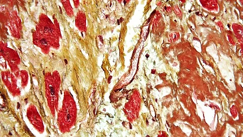 The Centers for Disease Control says heart disease is the leading cause of death among men and women in the United States. Heart disease can happen at any age, but the risk goes up as you get older.