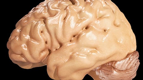 There is marked cortical atrophy in Alzheimer's Disease, associated with loss of gyri and sulci in the temporal lobe and parietal lobe, and parts of the frontal cortex and cingulate gyrus. Wikimedia Commons.