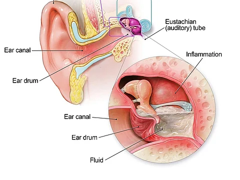 SSCD, a type of “third window syndrome,” is caused by an abnormal third mobile window of the inner ear.