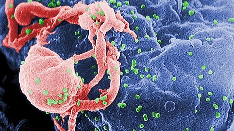 Scanning electron micrograph of HIV-1 budding (in green) from cultured lymphocyte. Multiple round bumps on the cell surface represent sites of assembly and budding of virions.