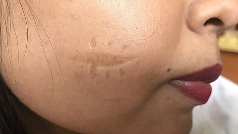 Healing often leaves a scar. But the role of the scar itself in healing is often underestimated: a scar that doesn’t heal cleanly can be painful or upsetting or affect the range of movement of the affected body part. It may even require further surgical treatment.