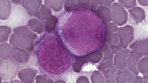 Acute myeloid leukemia (AML) is an aggressive form of cancer that originates in the bone marrow, rapidly spreads to the blood, and can quickly cause death if not treated promptly.