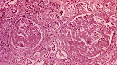 Researchers at the University of East Anglia have solved an 80-year-old medical mystery that causes kidney damage in children and can be fatal in babies.