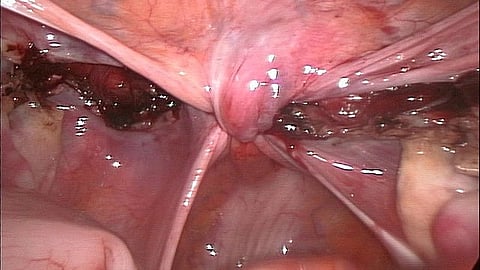 Laparoscopic hysterectomy