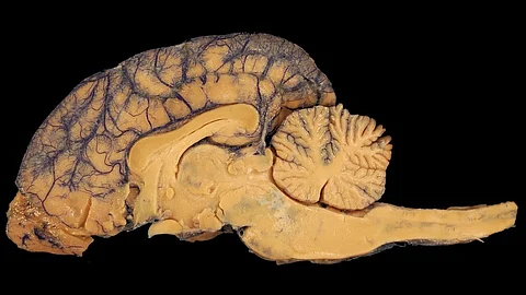 Low bone density and dementia are two conditions that commonly affect older people simultaneously