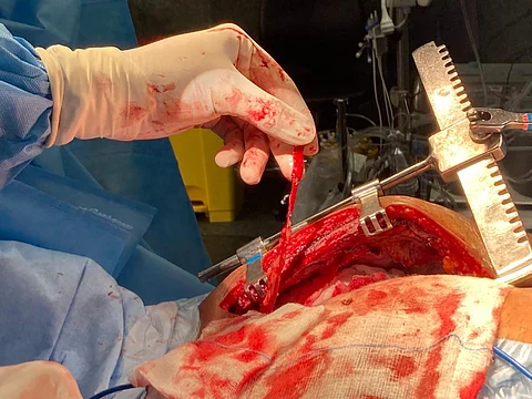 The image shows the left mammary artery used during coronary artery bypass and grafting. (Narayana Hrudayalaya, Bengaluru, India)