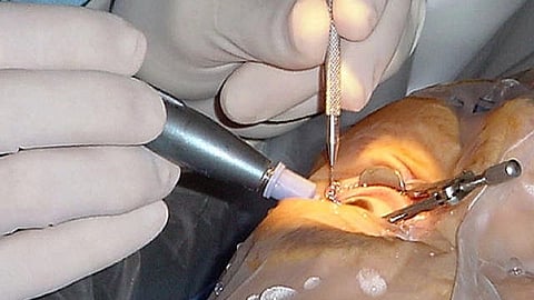 Post surgeries the hospital management informed the health department about the side effects in the eyes of 8 patients.(Representational image: Wikimedia Commons)